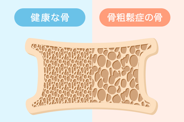 骨粗しょう症
